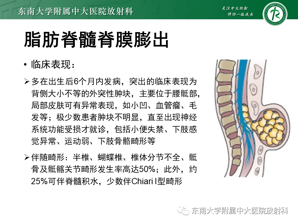 影像PPT - 【PPT】隐性神经管闭合不全-17 影像PPT - 【PPT】隐性神经管闭合不全-17