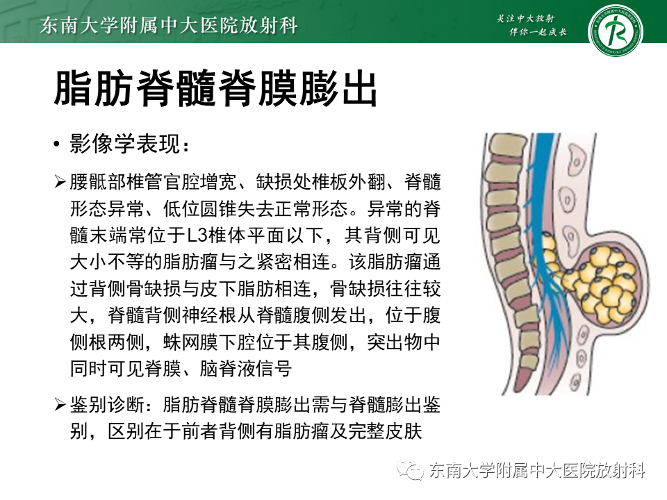 影像PPT - 【PPT】隐性神经管闭合不全-18 影像PPT - 【PPT】隐性神经管闭合不全-18