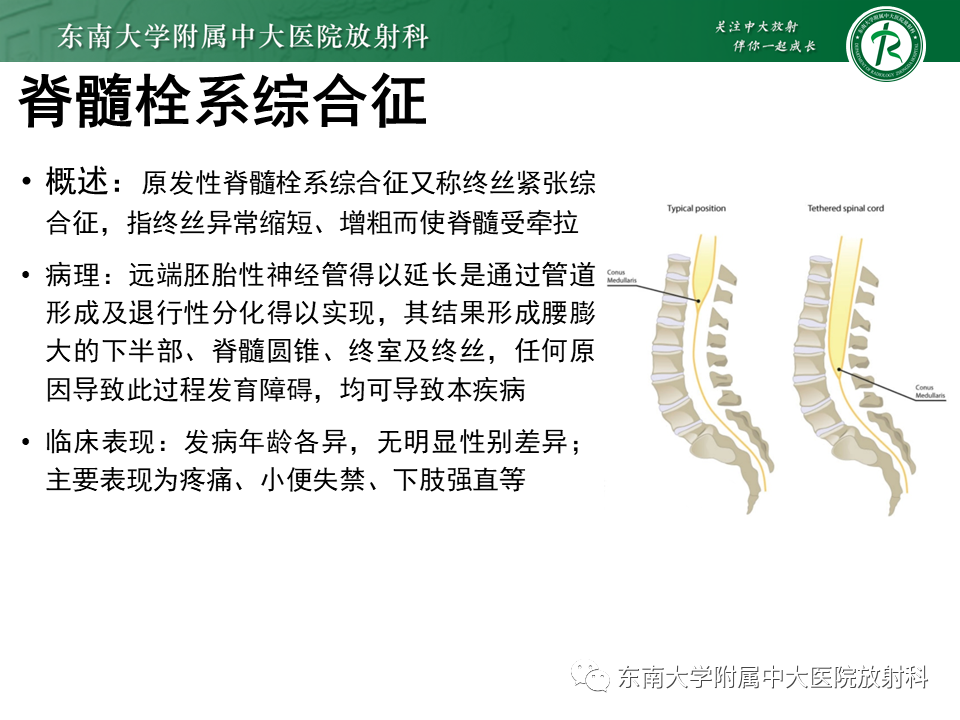 影像PPT - 【PPT】隐性神经管闭合不全-23 影像PPT - 【PPT】隐性神经管闭合不全-23