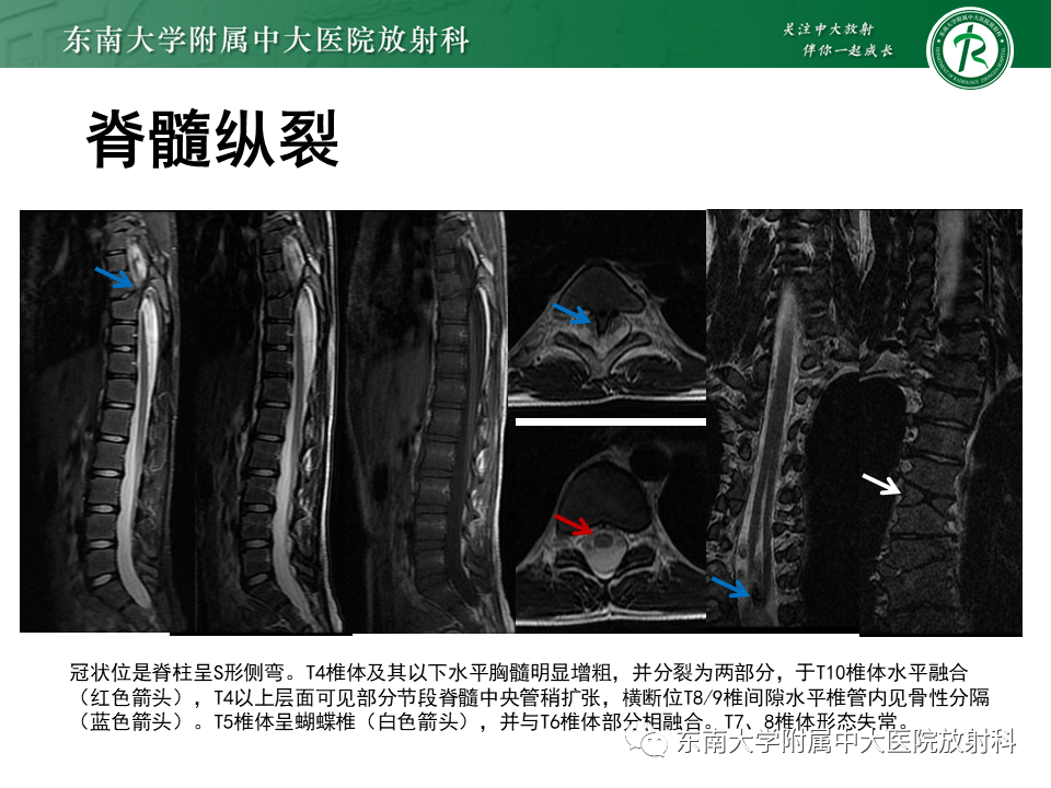影像PPT - 【PPT】隐性神经管闭合不全-22 影像PPT - 【PPT】隐性神经管闭合不全-22