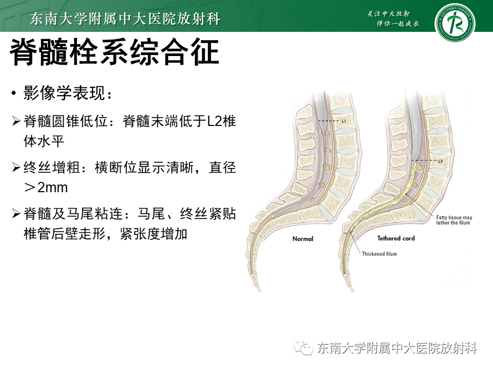 影像PPT - 【PPT】隐性神经管闭合不全-24 影像PPT - 【PPT】隐性神经管闭合不全-24