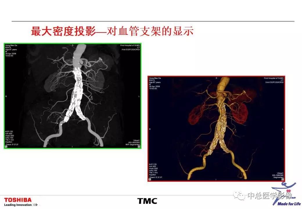 影像PPT - 【PPT】CT三维后处理技术应用-23