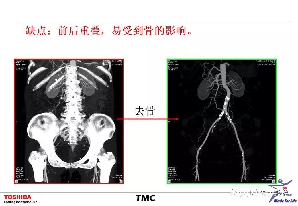 影像PPT - 【PPT】CT三维后处理技术应用-24
