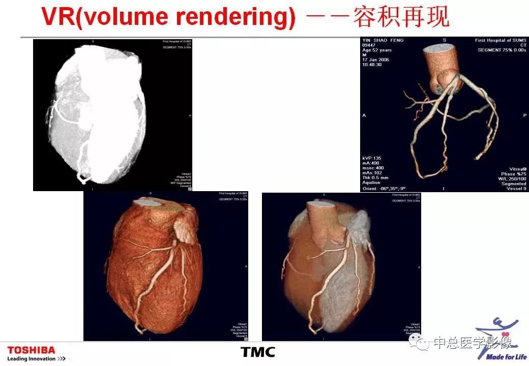 影像PPT - 【PPT】CT三维后处理技术应用-34