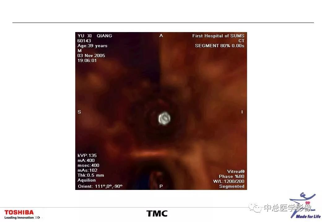 影像PPT - 【PPT】CT三维后处理技术应用-43