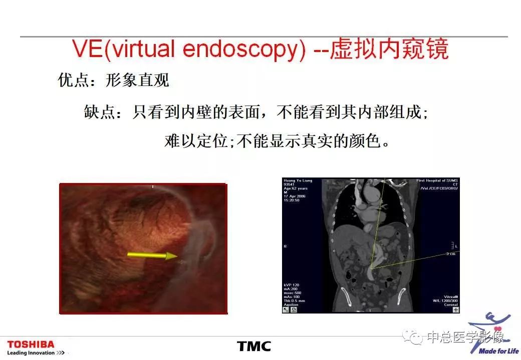 影像PPT - 【PPT】CT三维后处理技术应用-44
