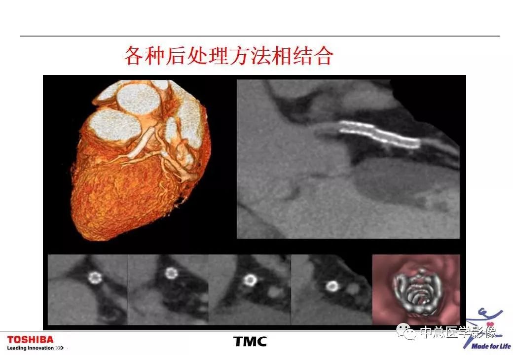 影像PPT - 【PPT】CT三维后处理技术应用-46