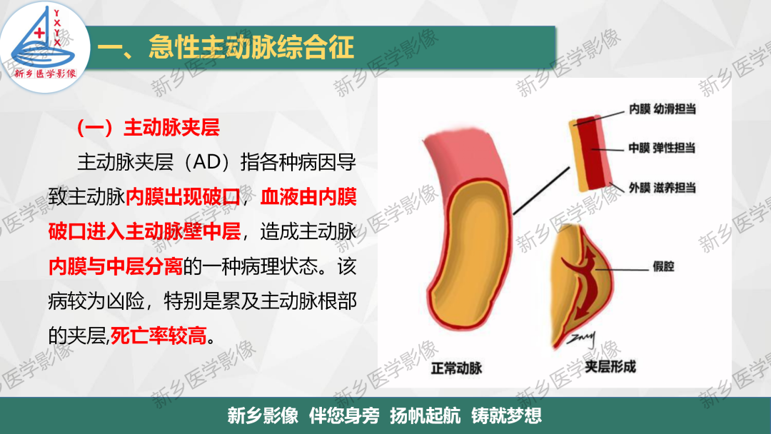 影像PPT - 【PPT】医学影像诊断学教材解读—主动脉病变的影像表现-3