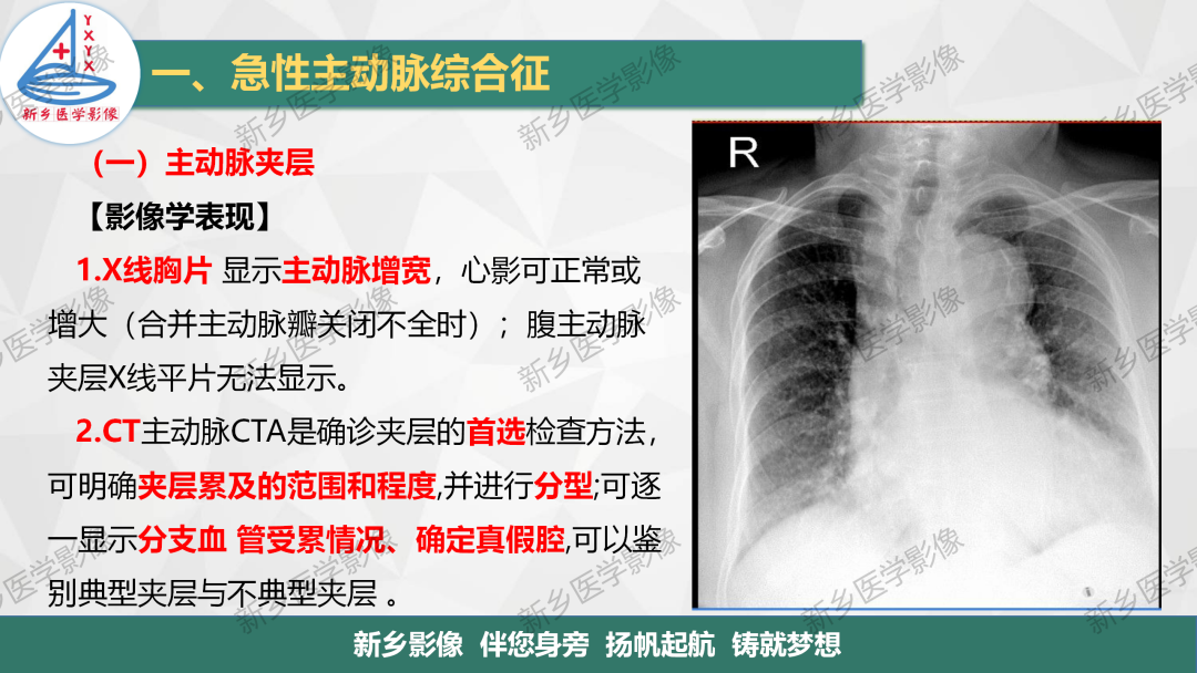影像PPT - 【PPT】医学影像诊断学教材解读—主动脉病变的影像表现-6