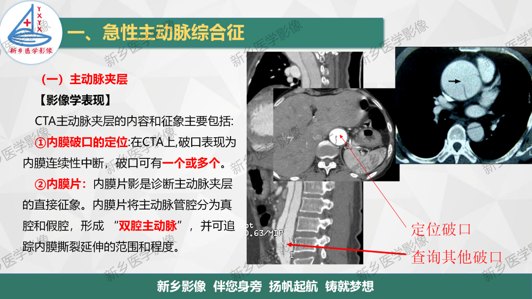 影像PPT - 【PPT】医学影像诊断学教材解读—主动脉病变的影像表现-7