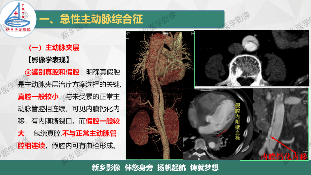 影像PPT - 【PPT】医学影像诊断学教材解读—主动脉病变的影像表现-8