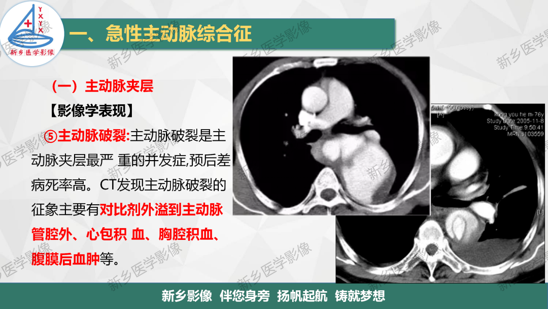 影像PPT - 【PPT】医学影像诊断学教材解读—主动脉病变的影像表现-10