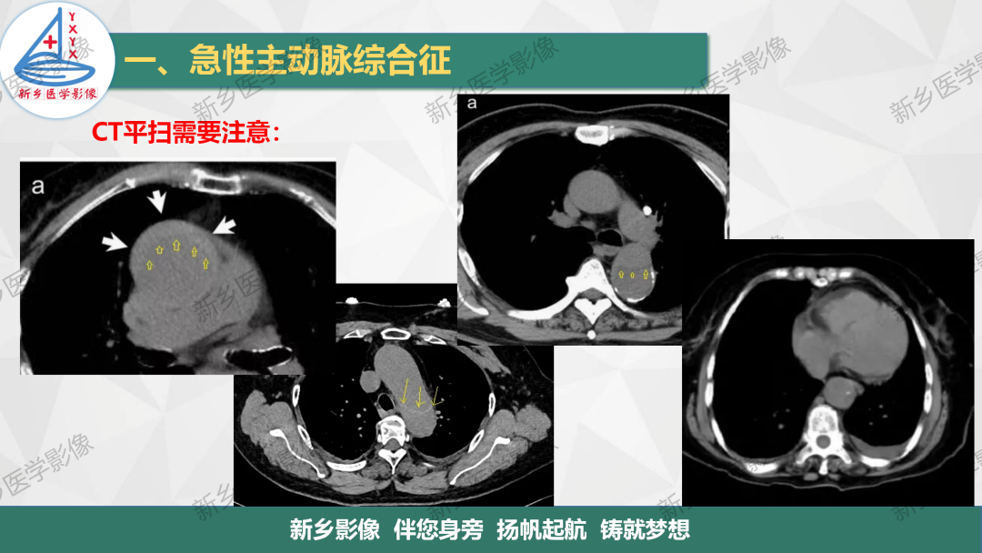 影像PPT - 【PPT】医学影像诊断学教材解读—主动脉病变的影像表现-11