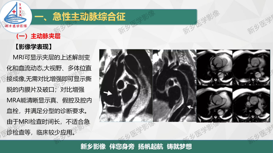 影像PPT - 【PPT】医学影像诊断学教材解读—主动脉病变的影像表现-12