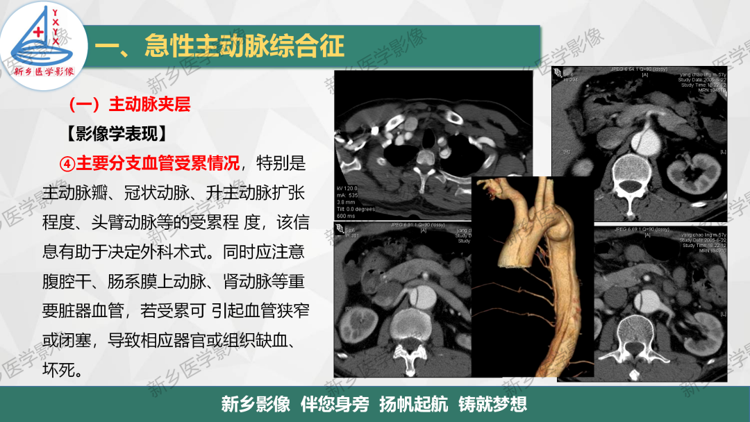 影像PPT - 【PPT】医学影像诊断学教材解读—主动脉病变的影像表现-9
