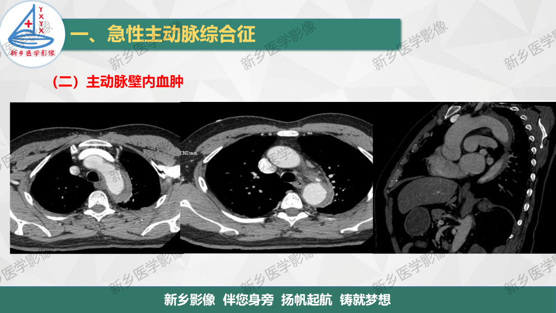 影像PPT - 【PPT】医学影像诊断学教材解读—主动脉病变的影像表现-15