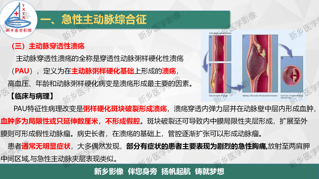 影像PPT - 【PPT】医学影像诊断学教材解读—主动脉病变的影像表现-17