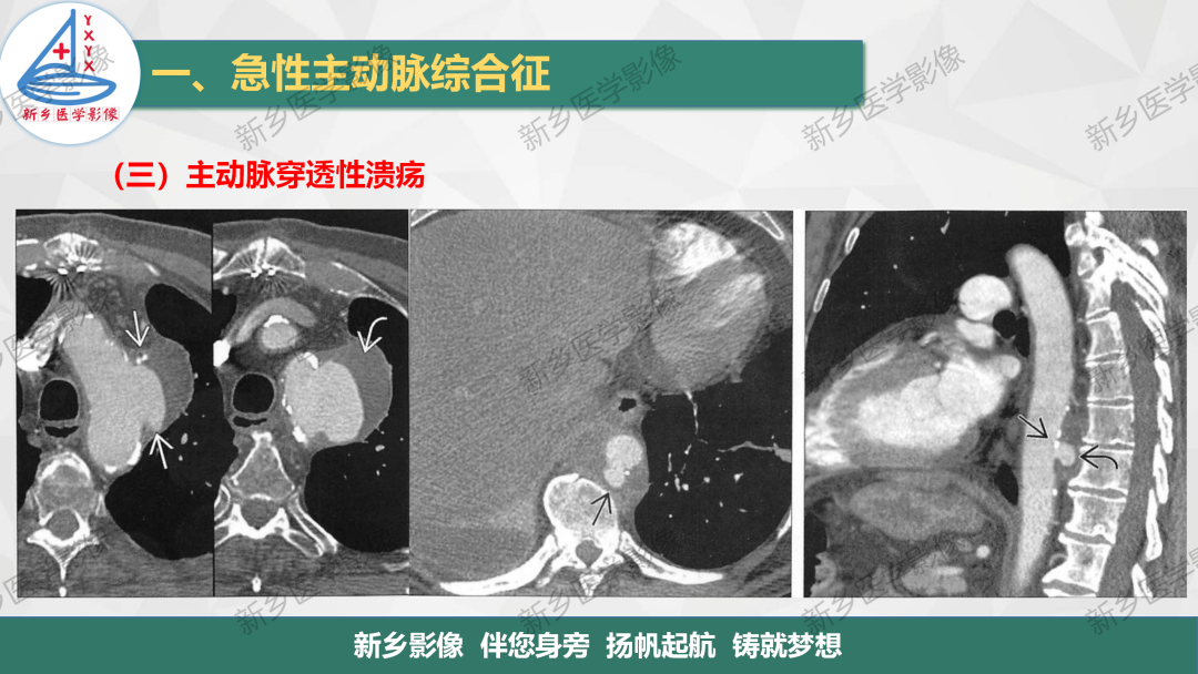影像PPT - 【PPT】医学影像诊断学教材解读—主动脉病变的影像表现-19