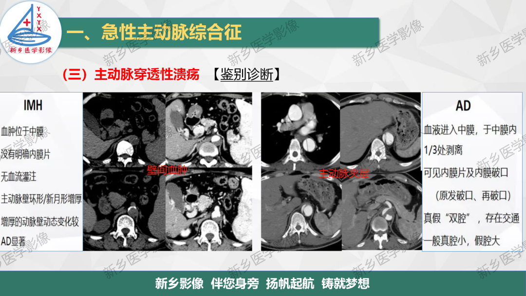 影像PPT - 【PPT】医学影像诊断学教材解读—主动脉病变的影像表现-20