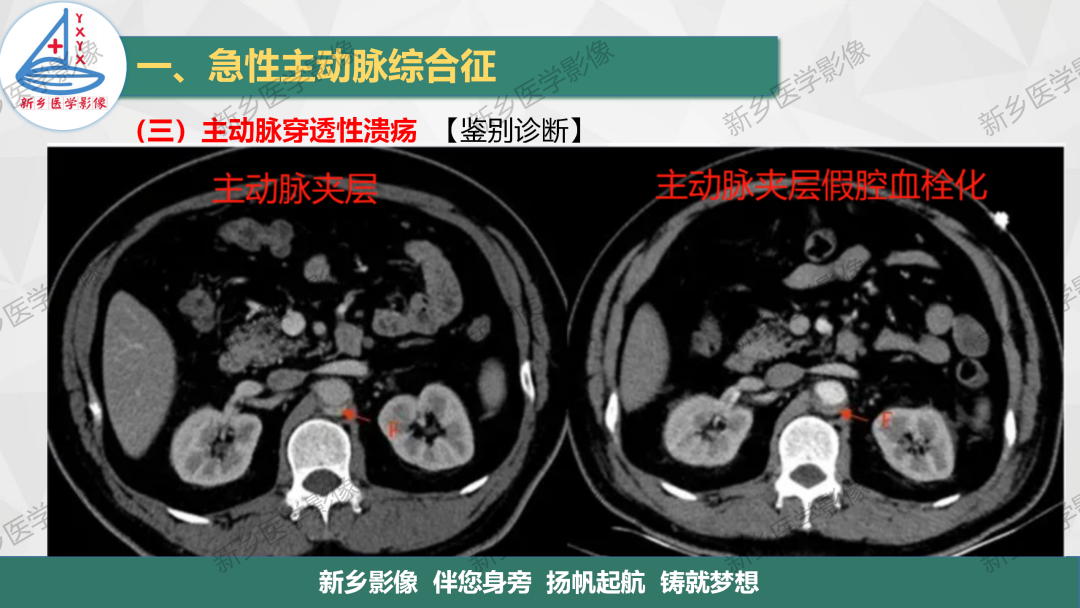 影像PPT - 【PPT】医学影像诊断学教材解读—主动脉病变的影像表现-21