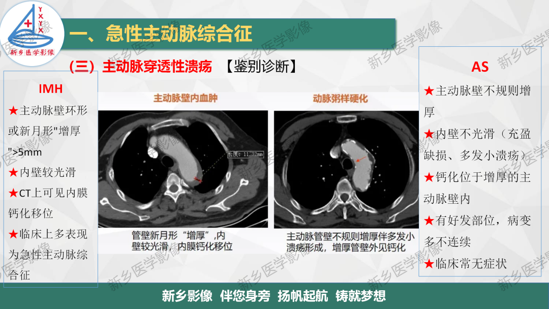 影像PPT - 【PPT】医学影像诊断学教材解读—主动脉病变的影像表现-22