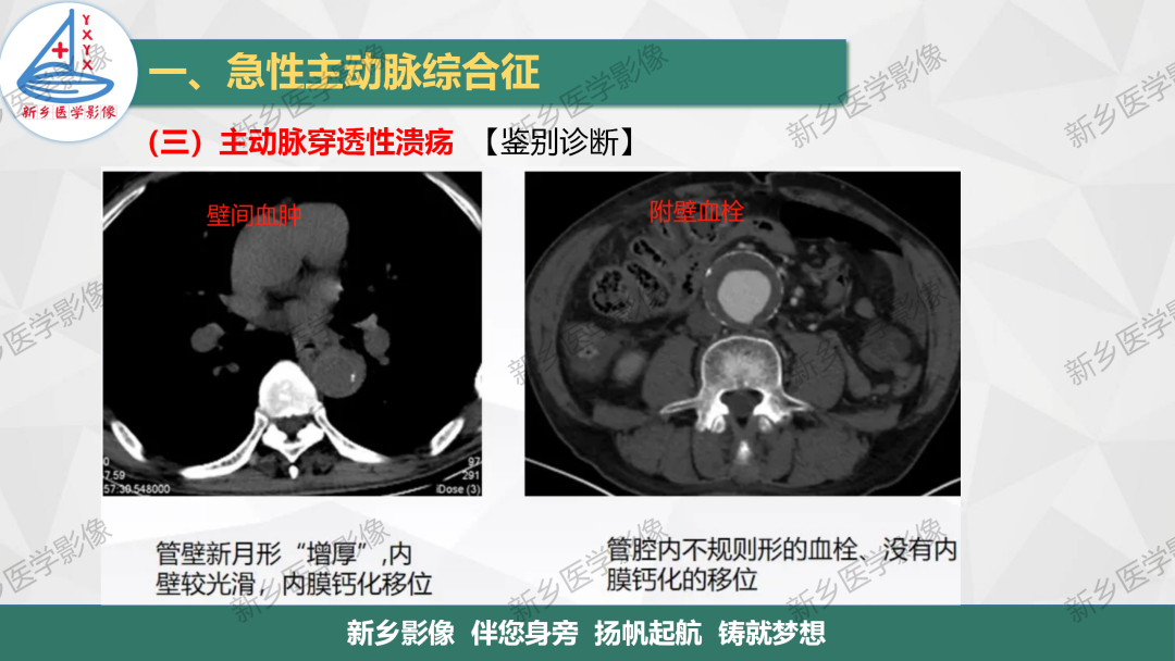影像PPT - 【PPT】医学影像诊断学教材解读—主动脉病变的影像表现-23