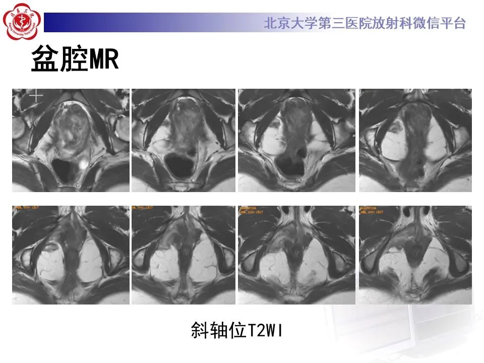 影像PPT - 【PPT】侵袭性血管粘液瘤-3