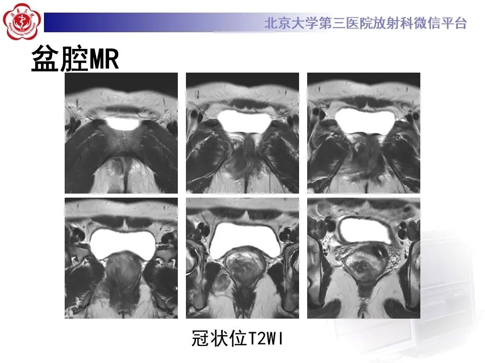 影像PPT - 【PPT】侵袭性血管粘液瘤-5