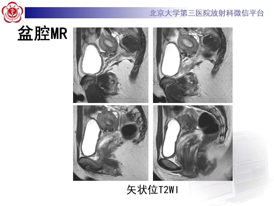 影像PPT - 【PPT】侵袭性血管粘液瘤-4