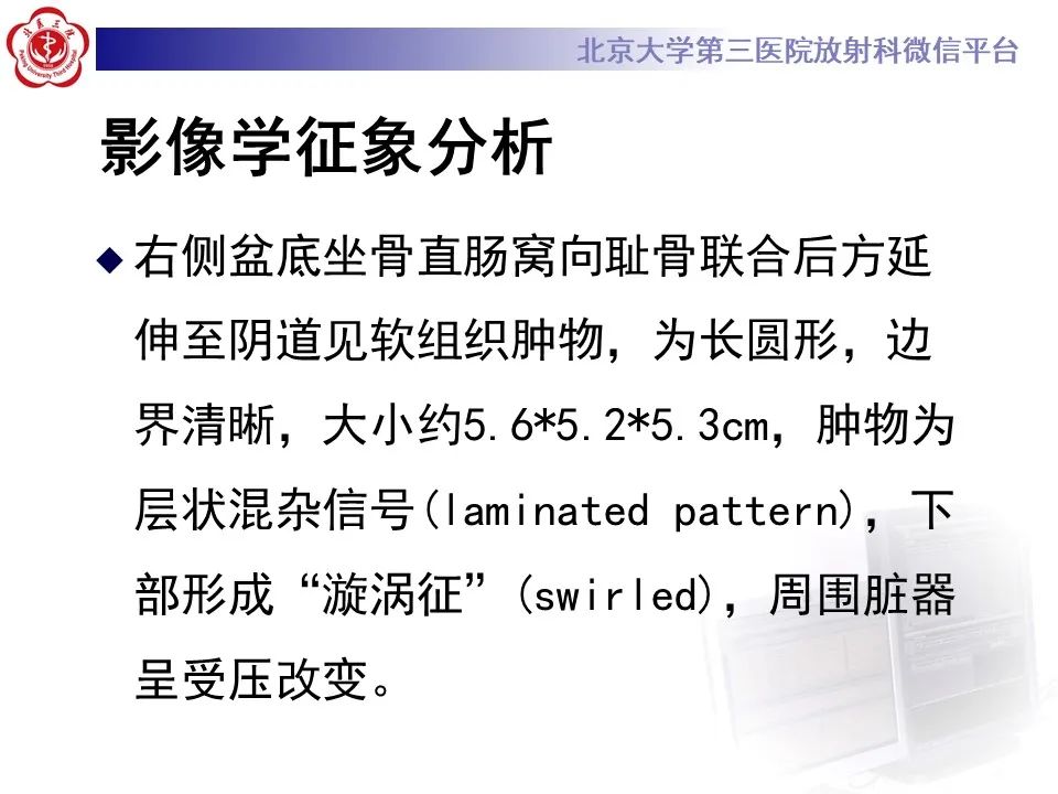 影像PPT - 【PPT】侵袭性血管粘液瘤-7