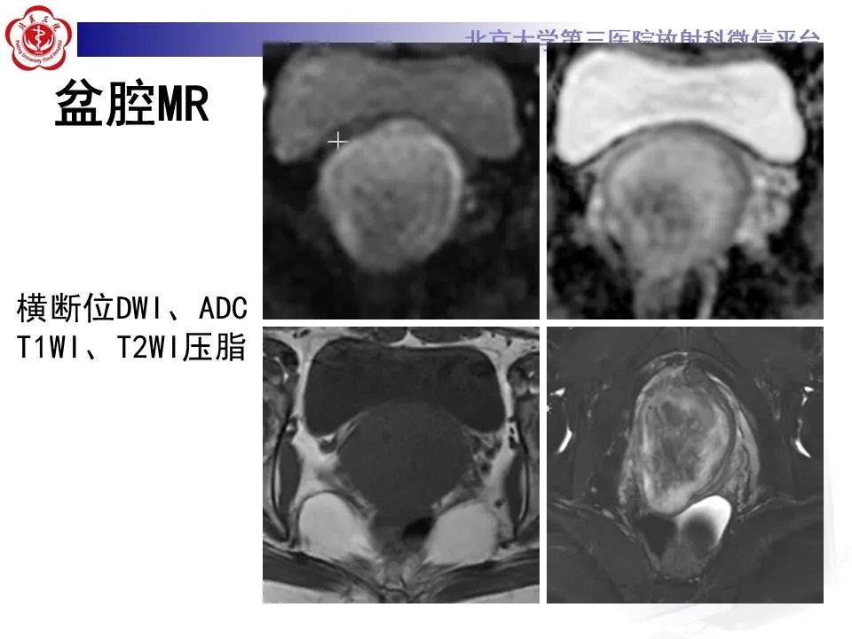 影像PPT - 【PPT】侵袭性血管粘液瘤-6