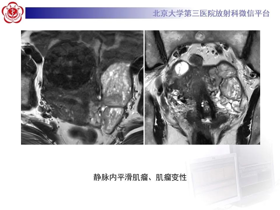 影像PPT - 【PPT】侵袭性血管粘液瘤-16