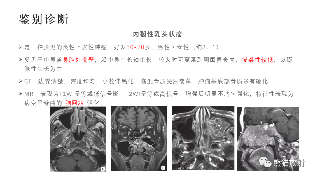 影像PPT - 【病例】嗅神经母细胞瘤2例MR-36