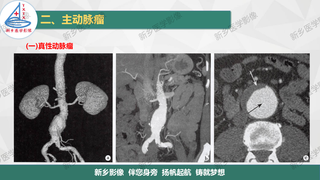 影像PPT - 【PPT】医学影像诊断学教材解读—主动脉病变的影像表现-5