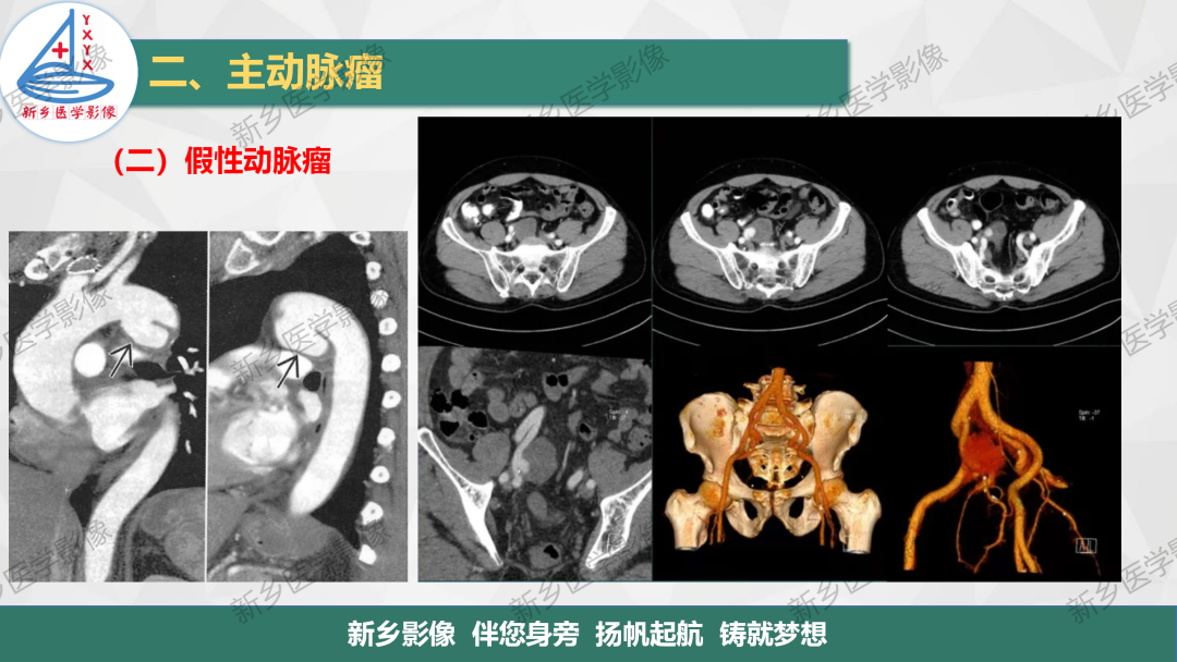影像PPT - 【PPT】医学影像诊断学教材解读—主动脉病变的影像表现-9
