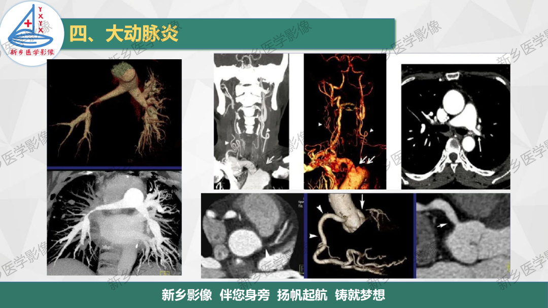 影像PPT - 【PPT】医学影像诊断学教材解读—主动脉病变的影像表现-18