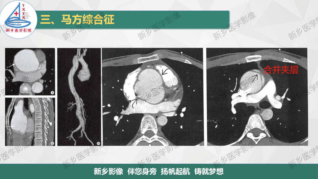 影像PPT - 【PPT】医学影像诊断学教材解读—主动脉病变的影像表现-13