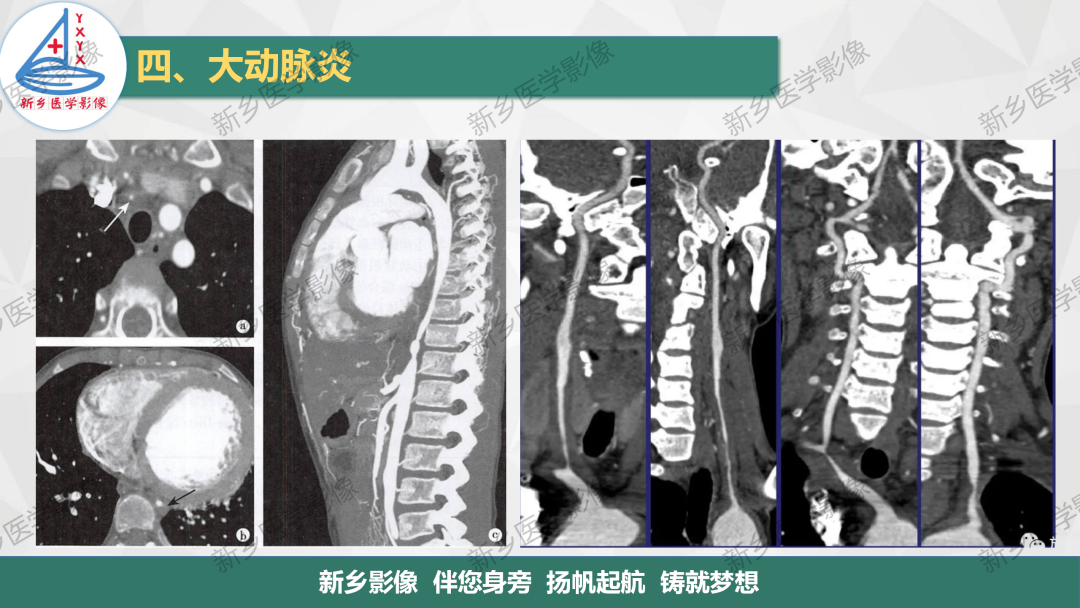 影像PPT - 【PPT】医学影像诊断学教材解读—主动脉病变的影像表现-17