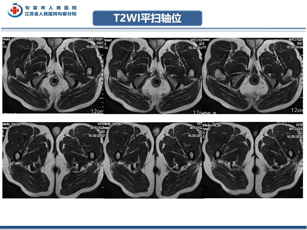 影像PPT - 【PPT】肛瘘-4