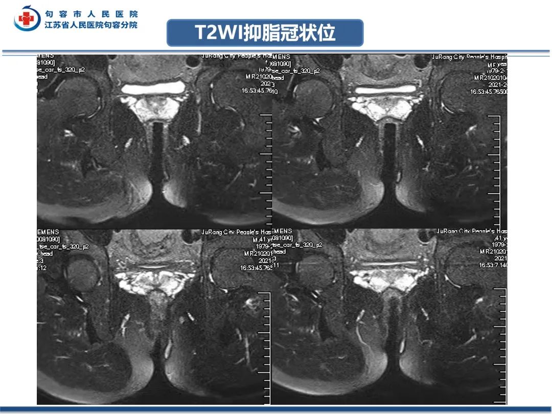 影像PPT - 【PPT】肛瘘-6