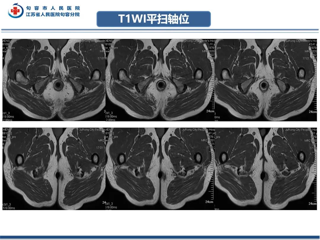 影像PPT - 【PPT】肛瘘-3