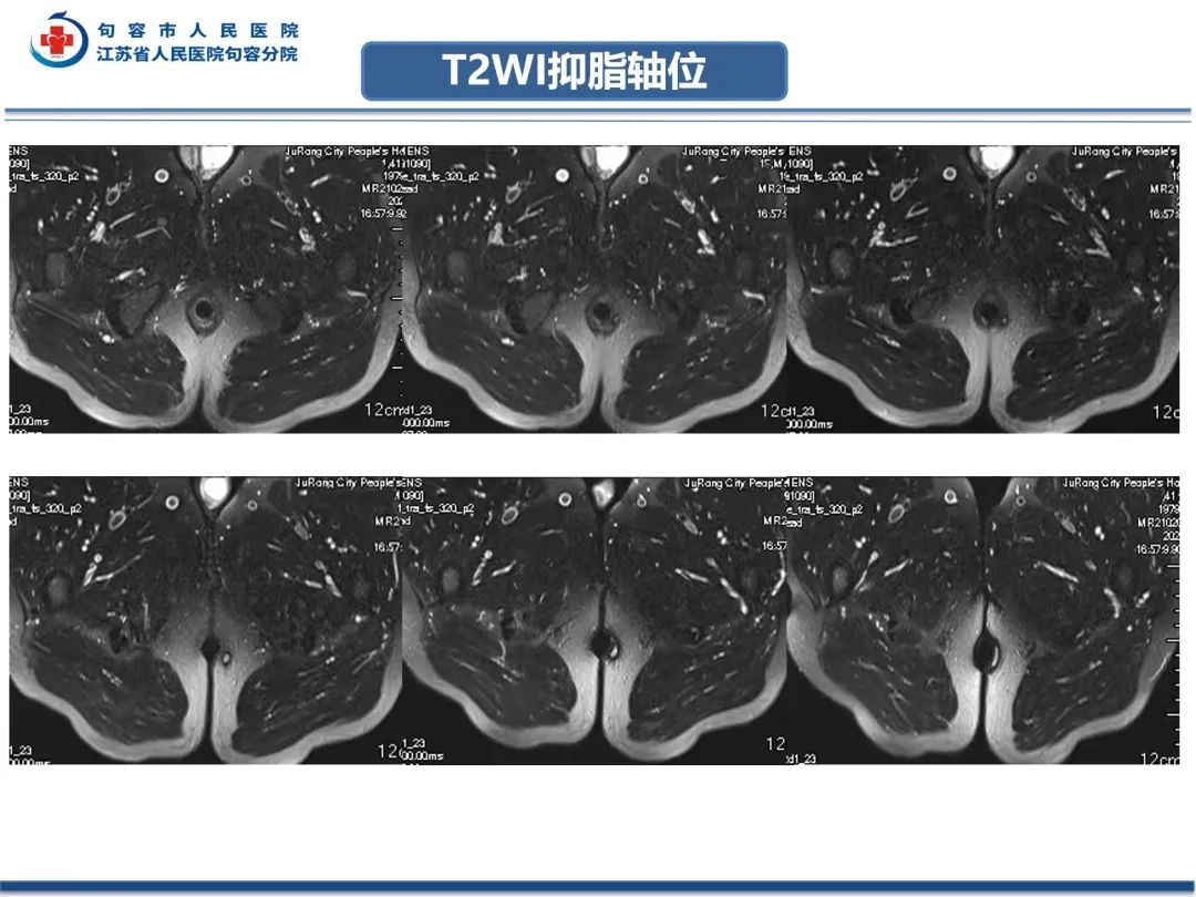 影像PPT - 【PPT】肛瘘-5