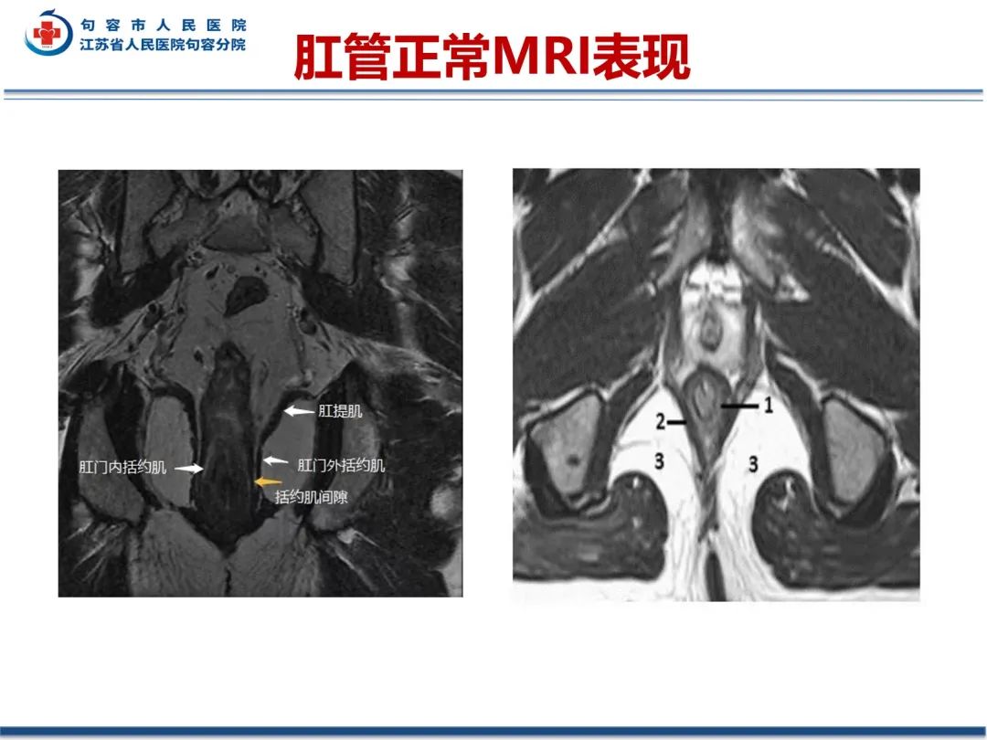 影像PPT - 【PPT】肛瘘-22