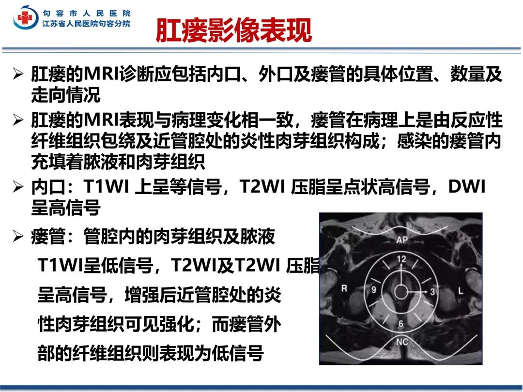 影像PPT - 【PPT】肛瘘-23