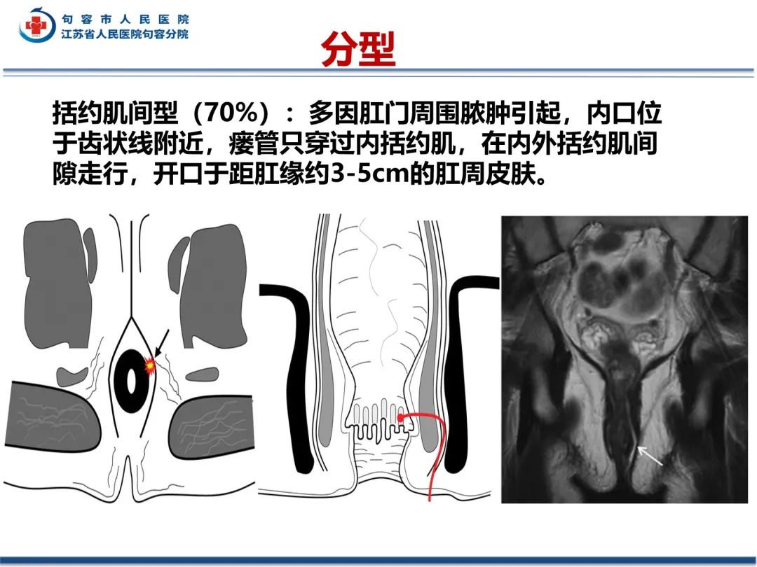 影像PPT - 【PPT】肛瘘-25