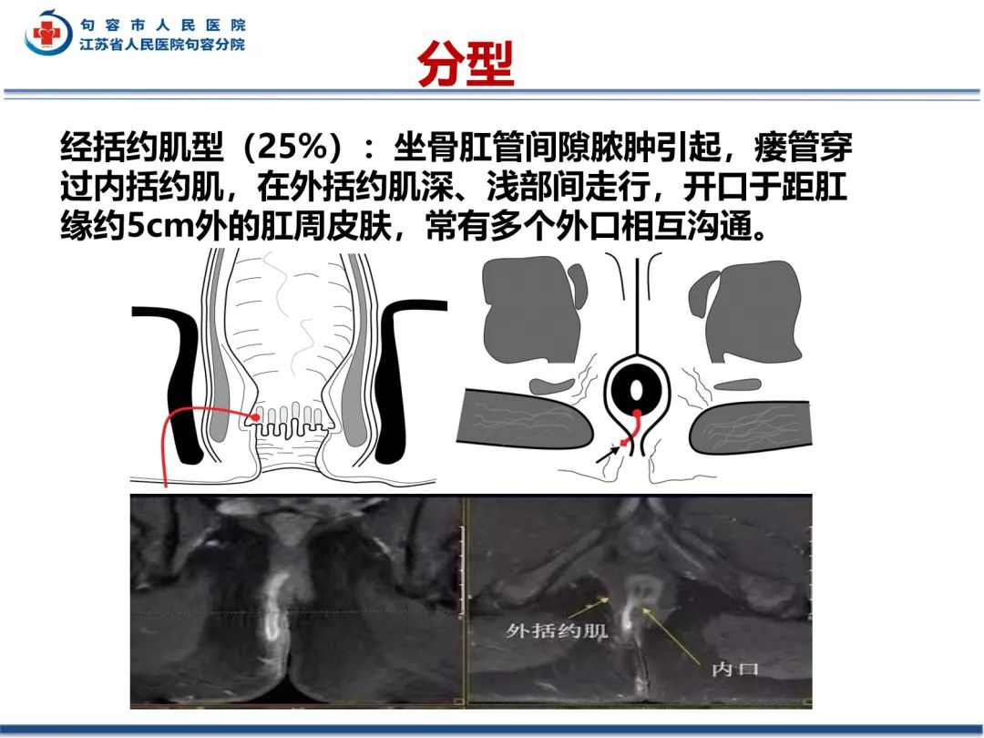 影像PPT - 【PPT】肛瘘-26