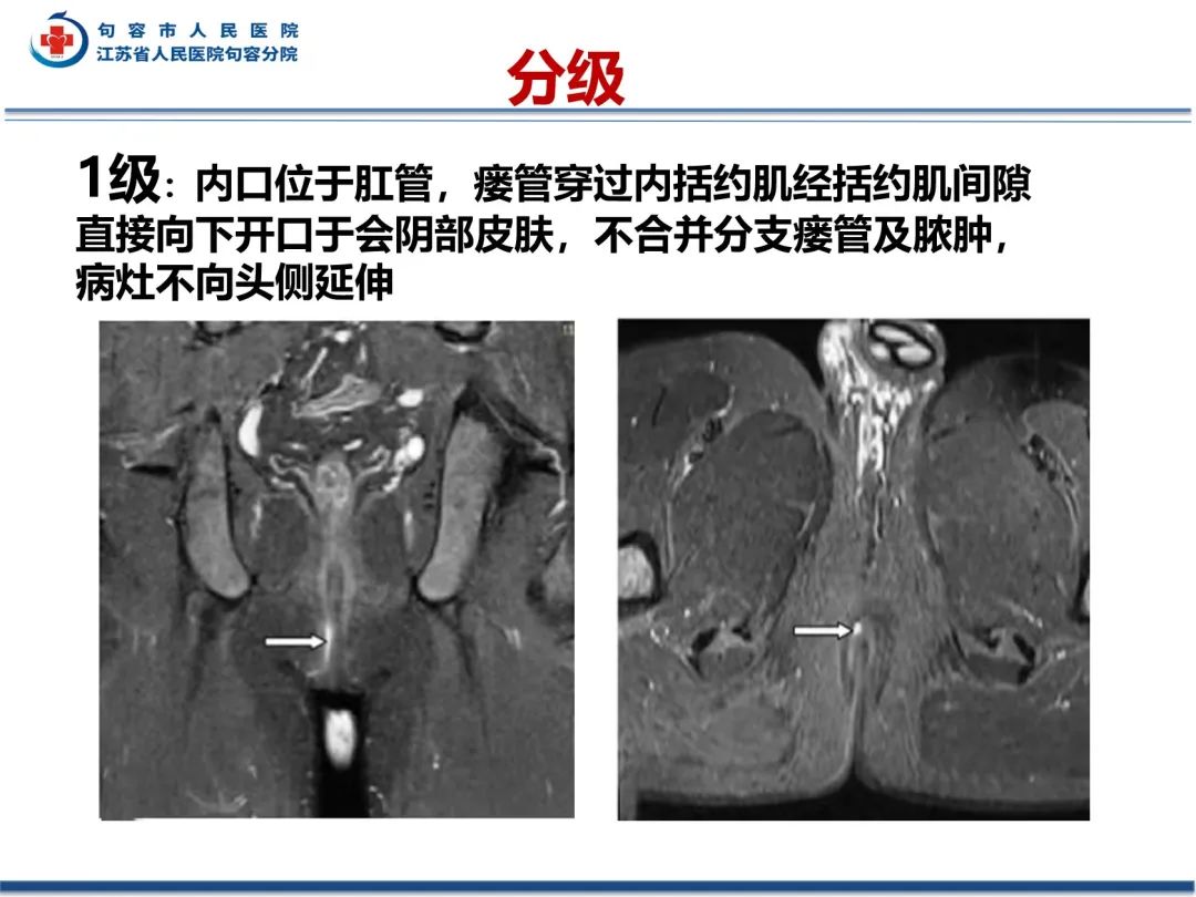 影像PPT - 【PPT】肛瘘-30