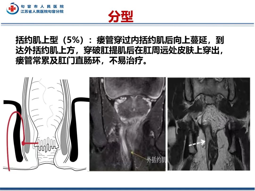 影像PPT - 【PPT】肛瘘-27