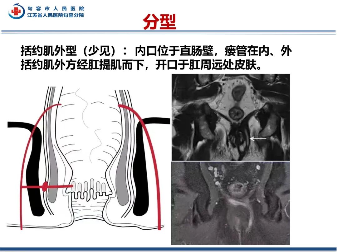 影像PPT - 【PPT】肛瘘-28