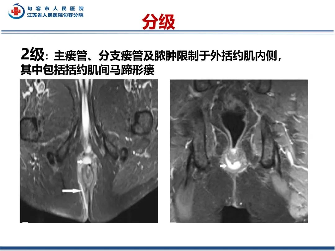 影像PPT - 【PPT】肛瘘-31